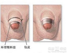 龟头突发红斑， 